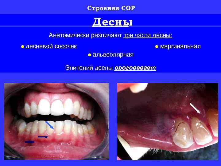 Строение СОР Десны Анатомически различают три части десны: ● десневой сосочек ● маргинальная ●
