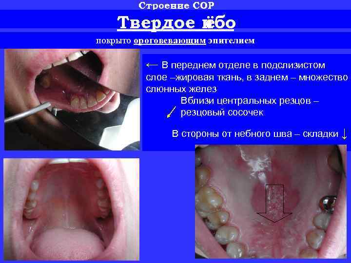 Строение СОР Твердое н ёбо покрыто ороговевающим эпителием ← В переднем отделе в подслизистом