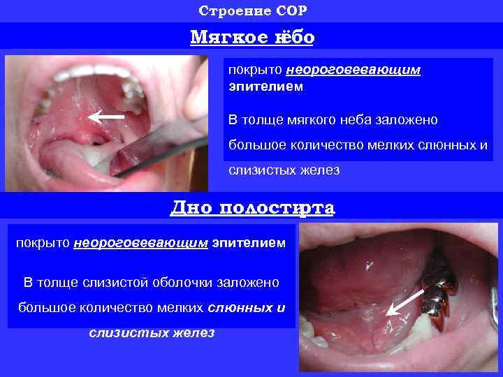 Строение СОР Мягкое н ёбо покрыто неороговевающим эпителием В толще мягкого неба заложено большое