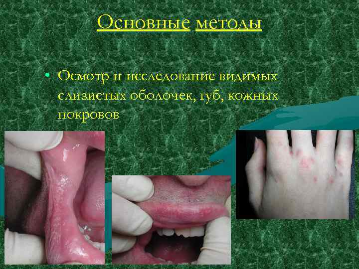 Основные методы • Осмотр и исследование видимых слизистых оболочек, губ, кожных покровов 