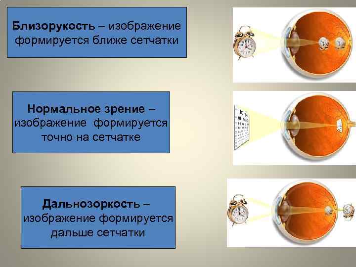 Близорукость – изображение формируется ближе сетчатки Нормальное зрение – изображение формируется точно на сетчатке