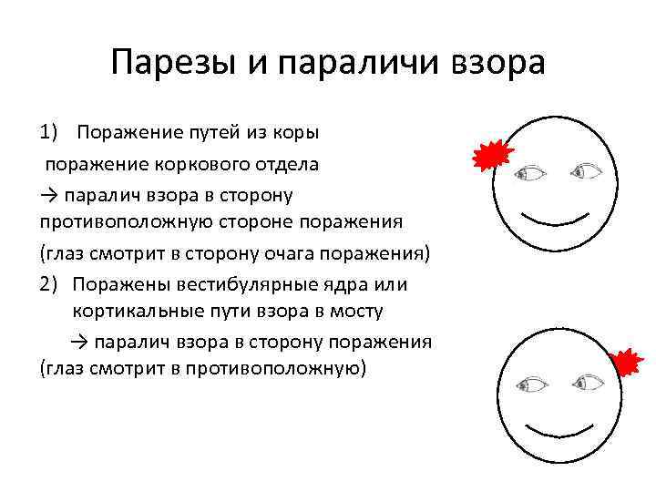 Парезы и параличи взора 1) Поражение путей из коры поражение коркового отдела → паралич