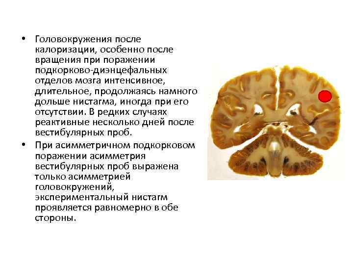 Дисфункция стволового мозга
