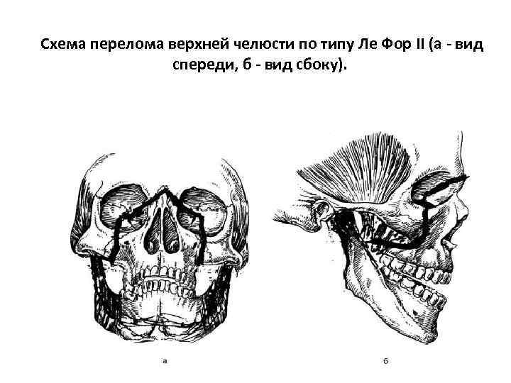 Перелом верхней челюсти карта вызова смп