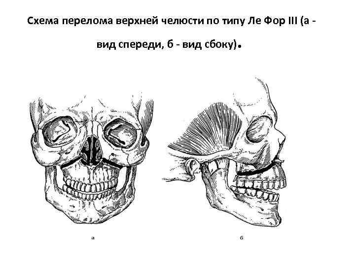 Перелом верхней челюсти. Лефор переломы верхней челюсти. Перелом нижней челюсти по Лефору. Перелом верхней челюсти III типа по Ле фору. Переломы нижней челюсти по Ле фор.