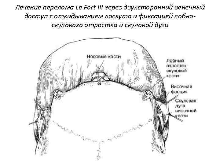 Лечение перелома Le Fort III через двухсторонний венечный доступ с откидыванием лоскута и фиксацией