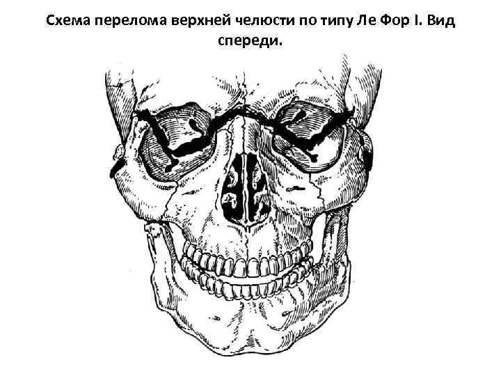 Перелом верхней челюсти презентация