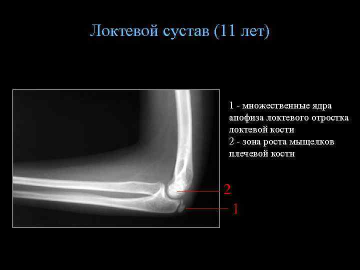 Локтевой сустав (11 лет) 1 - множественные ядра апофиза локтевого отростка локтевой кости 2