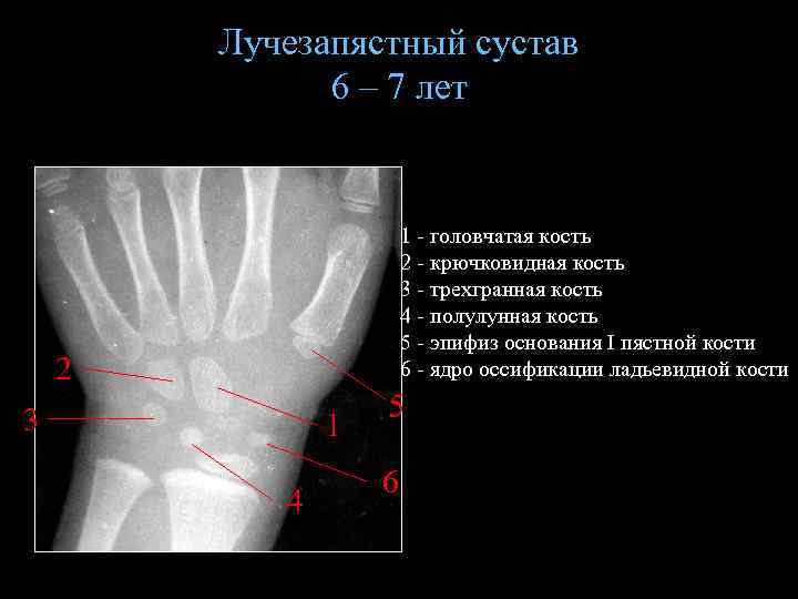 Лучезапястный сустав 6 – 7 лет 1 - головчатая кость 2 - крючковидная кость