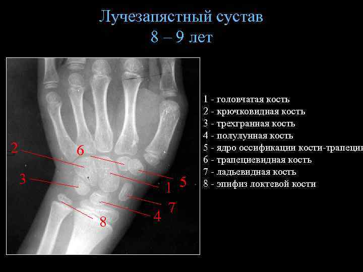 Лучезапястный сустав 8 – 9 лет 2 6 3 8 4 1 5 7