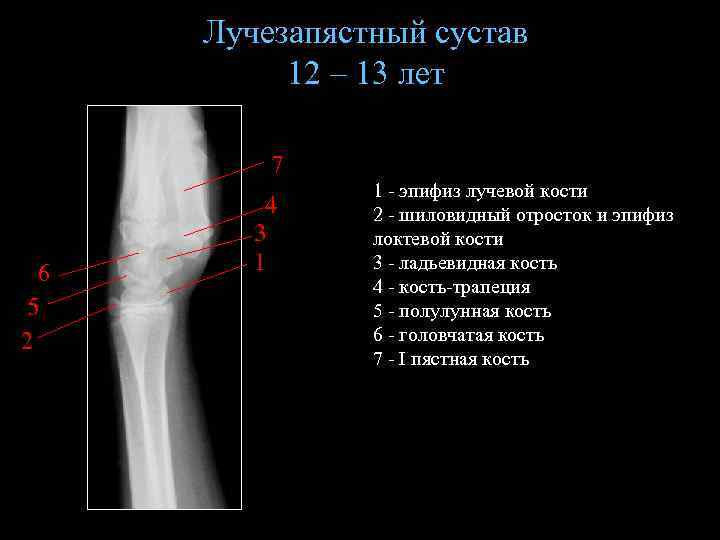 Лучезапястный сустав 12 – 13 лет 7 6 5 2 4 3 1 1