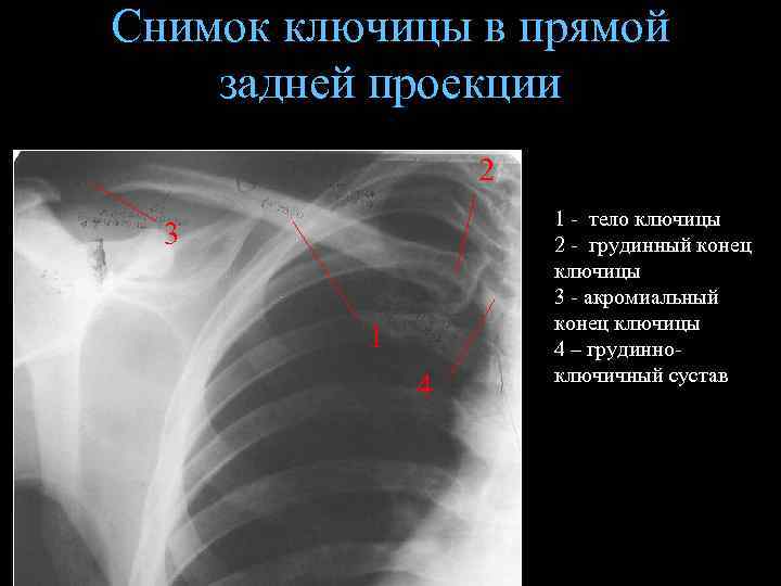 Снимок ключицы в прямой задней проекции 2 3 1 4 1 - тело ключицы