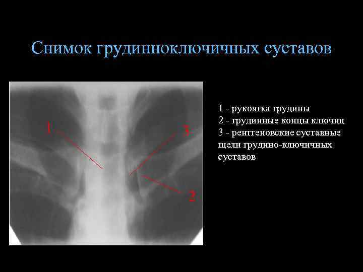 Снимок грудинноключичных суставов 1 3 2 1 - рукоятка грудины 2 - грудинные концы