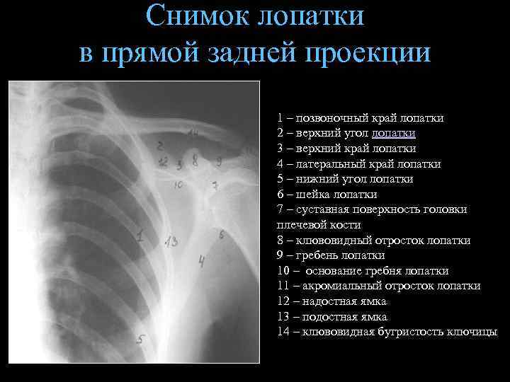 Снимок лопатки в прямой задней проекции 1 – позвоночный край лопатки 2 – верхний