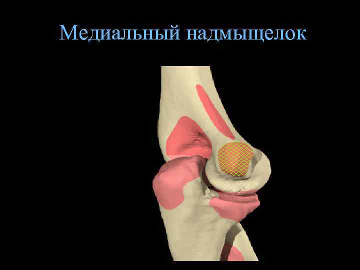 Медиальный надмыщелок 