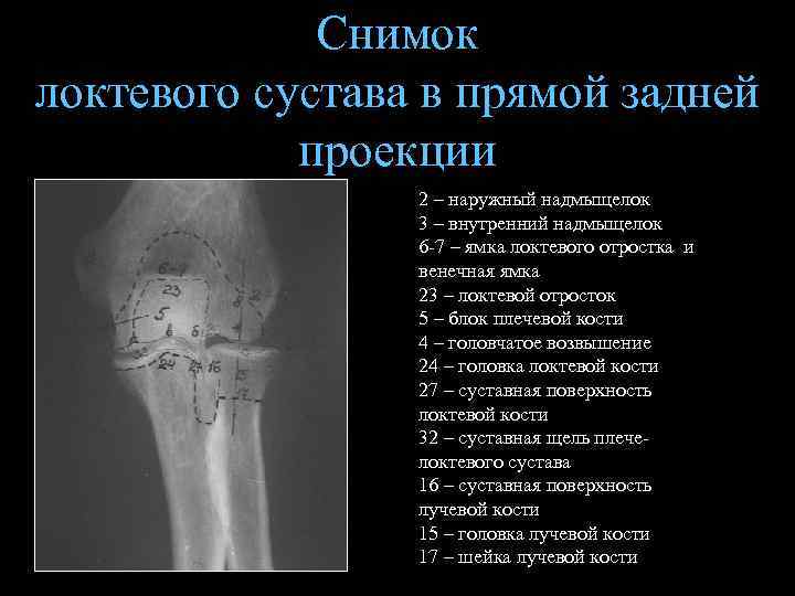 Снимок локтевого сустава в прямой задней проекции 2 – наружный надмыщелок 3 – внутренний