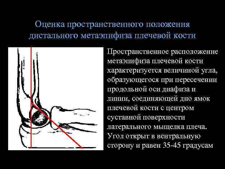 Оценка пространственного положения дистального метаэпифиза плечевой кости Пространственное расположение метаэпифиза плечевой кости характеризуется величиной