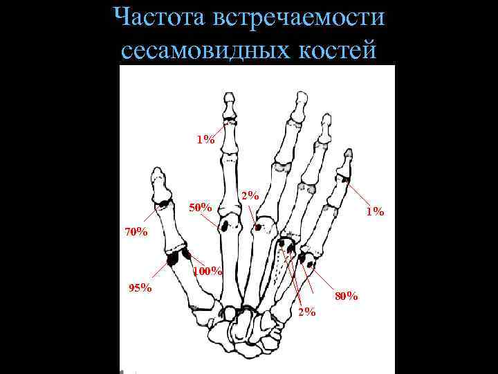 Частота встречаемости сесамовидных костей 1% 50% 2% 1% 70% 100% 95% 6% 2% 80%