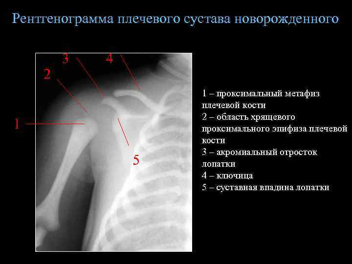 Рентгенограмма плечевого сустава новорожденного 2 3 4 1 5 1 – проксимальный метафиз плечевой