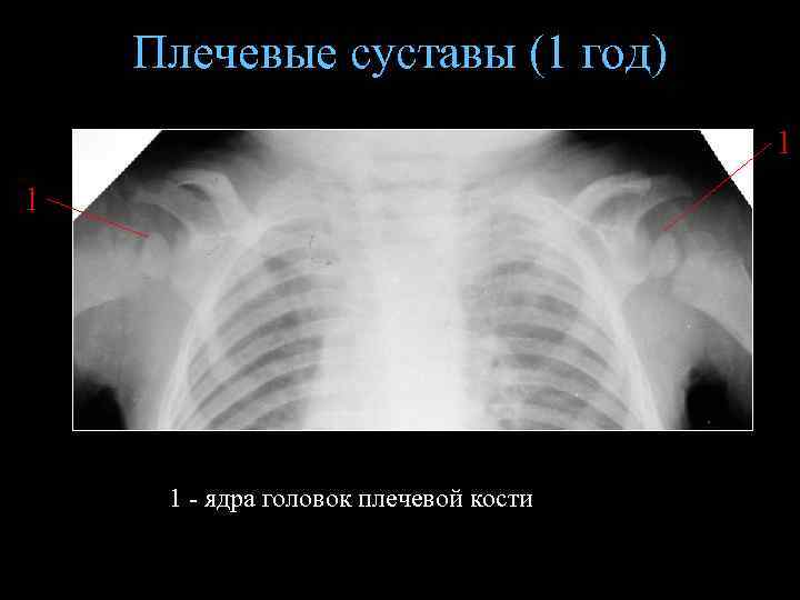 Плечевые суставы (1 год) 1 1 1 - ядра головок плечевой кости 