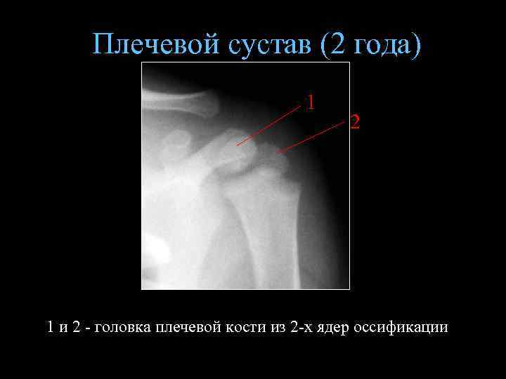 Плечевой сустав (2 года) 1 2 1 и 2 - головка плечевой кости из