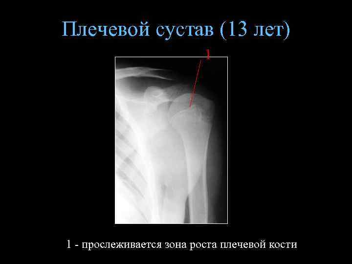 Плечевой сустав (13 лет) 1 1 - прослеживается зона роста плечевой кости 