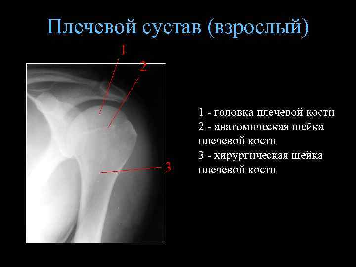 Плечевой сустав (взрослый) 1 2 3 1 - головка плечевой кости 2 - анатомическая