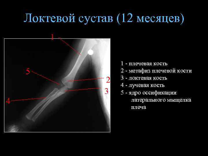 Локтевой сустав (12 месяцев) 1 5 4 2 3 1 - плечевая кость 2