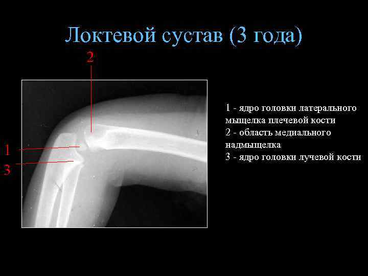 Локтевой сустав (3 года) 2 1 3 1 - ядро головки латерального мыщелка плечевой