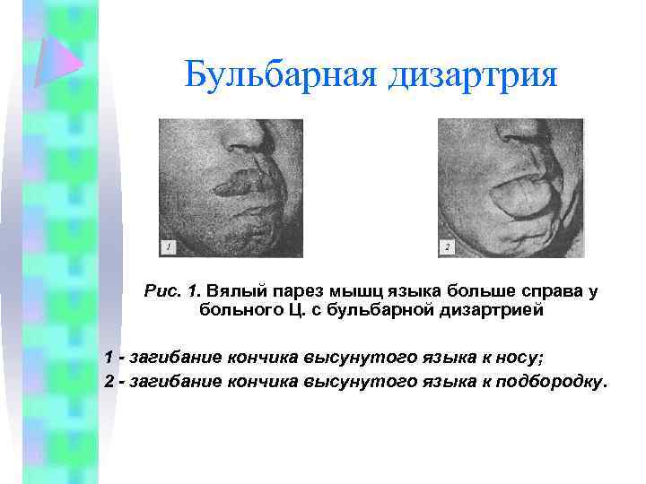 Бульбарная дизартрия Рис. 1. Вялый парез мышц языка больше справа у больного Ц. с