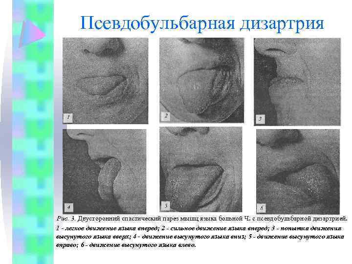 Корковая дизартрия фото