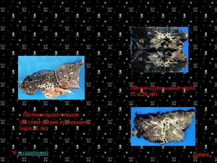  Лёгкие курильщика через 15 и 20 лет Лёгочно-дыхательная система лёгкие курильщика через 5