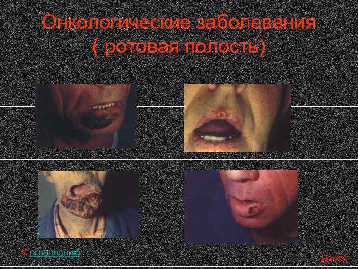 Онкологические заболевания ( ротовая полость) К оглавлению Далее 