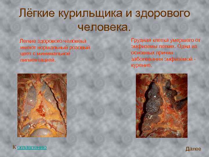 Лёгкие курильщика и здорового человека. Легкие здорового человека имеют нормальный розовый цвет с минимальной