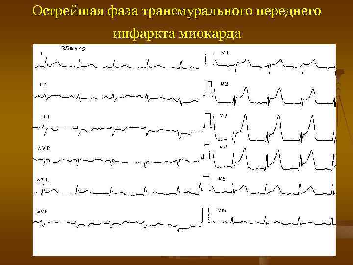 Признаки трансмурального инфаркта. Трансмуральный инфаркт миокарда на ЭКГ. Острый трансмуральный инфаркт миокарда ЭКГ. Острая стадия трансмурального инфаркта. Трансмуральный инфаркт острейшая стадия.