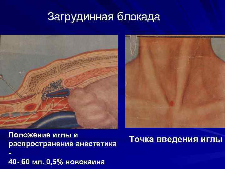 Загрудинная блокада Положение иглы и распространение анестетика 40 - 60 мл. 0, 5% новокаина