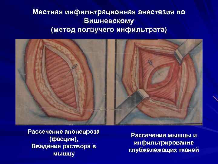 Что такое инфильтрат фото