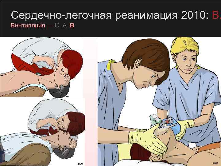 Сердечно-легочная реанимация 2010: B. Вентиляция — C–A–B 