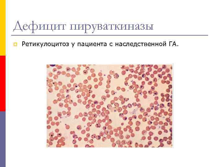 Дефицит пируваткиназы p Ретикулоцитоз у пациента с наследственной ГА. 