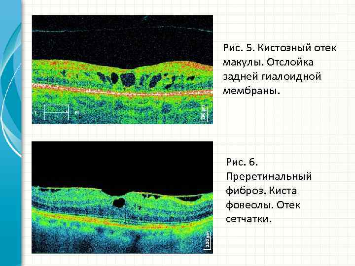Рис. 5. Кистозный отек макулы. Отслойка задней гиалоидной мембраны. Рис. 6. Преретинальный фиброз. Киста