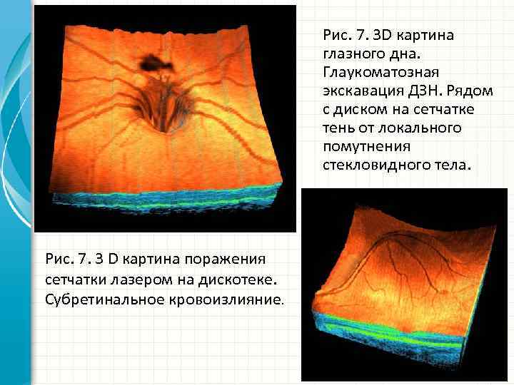 Рис. 7. 3 D картина глазного дна. Глаукоматозная экскавация ДЗН. Рядом с диском на
