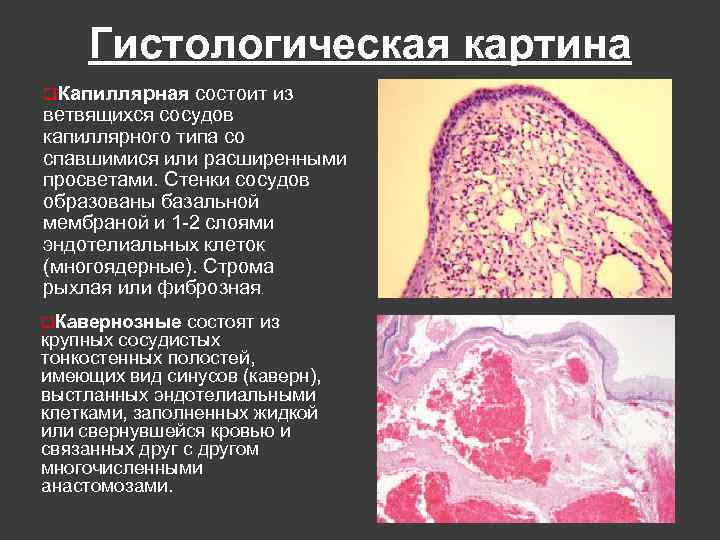 Гистологическая картина q. Капиллярная состоит из ветвящихся сосудов капиллярного типа со спавшимися или расширенными