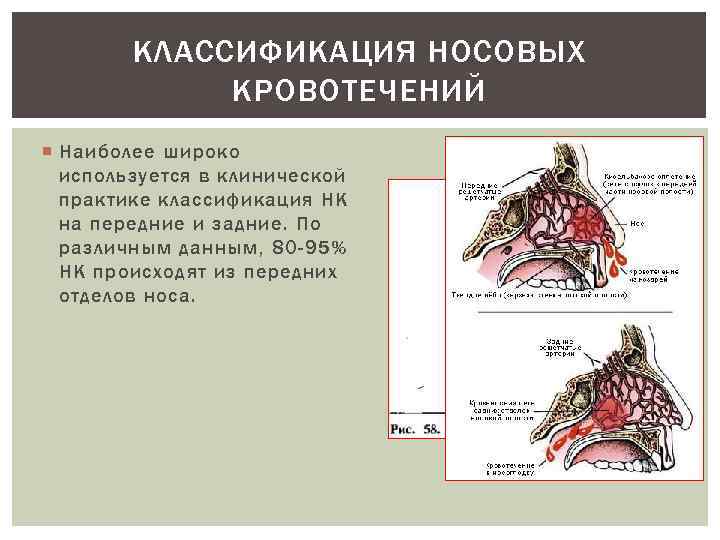 КЛАССИФИКАЦИЯ НОСОВЫХ КРОВОТЕЧЕНИЙ Наиболее широко используется в клинической практике классификация НК на передние и