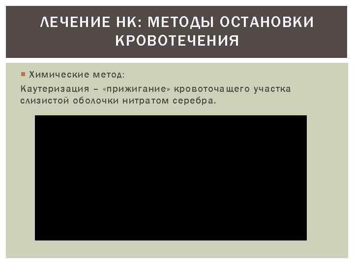 ЛЕЧЕНИЕ НК: МЕТОДЫ ОСТАНОВКИ КРОВОТЕЧЕНИЯ Химические метод: Каутеризация – «прижигание» кровоточащего участка слизистой оболочки