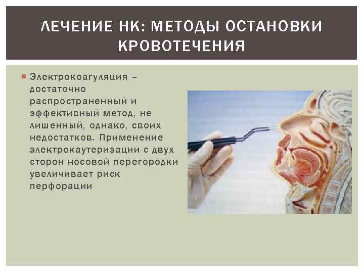 ЛЕЧЕНИЕ НК: МЕТОДЫ ОСТАНОВКИ КРОВОТЕЧЕНИЯ Электрокоагуляция – достаточно распространенный и эффективный метод, не лишенный,