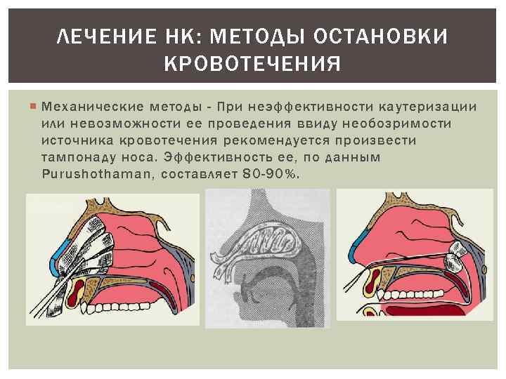 ЛЕЧЕНИЕ НК: МЕТОДЫ ОСТАНОВКИ КРОВОТЕЧЕНИЯ Механические методы - При неэффективности каутеризации или невозможности ее