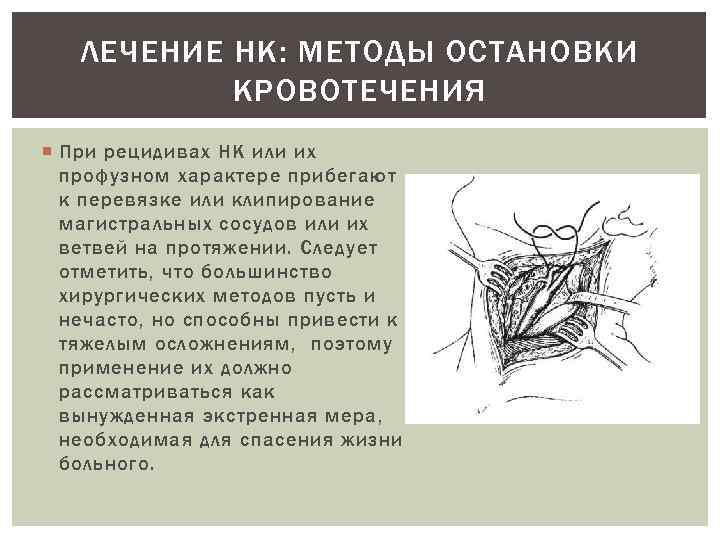 ЛЕЧЕНИЕ НК: МЕТОДЫ ОСТАНОВКИ КРОВОТЕЧЕНИЯ При рецидивах НК или их профузном характере прибегают к