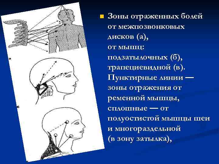 n Зоны отраженных болей от межпозвонковых дисков (а), от мышц: подзатылочных (б), трапециевидной (в).