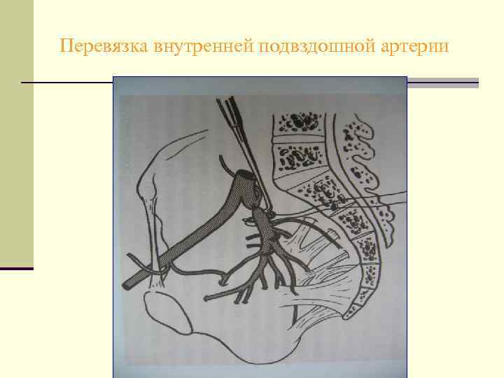 Перевязка внутренней подвздошной артерии 