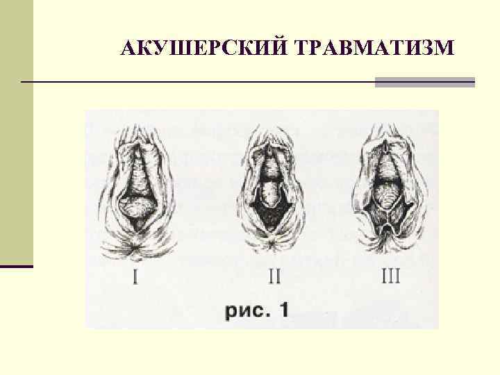 АКУШЕРСКИЙ ТРАВМАТИЗМ 